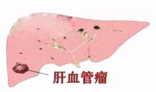 治血管瘤要多少钱 治血管瘤要多少钱